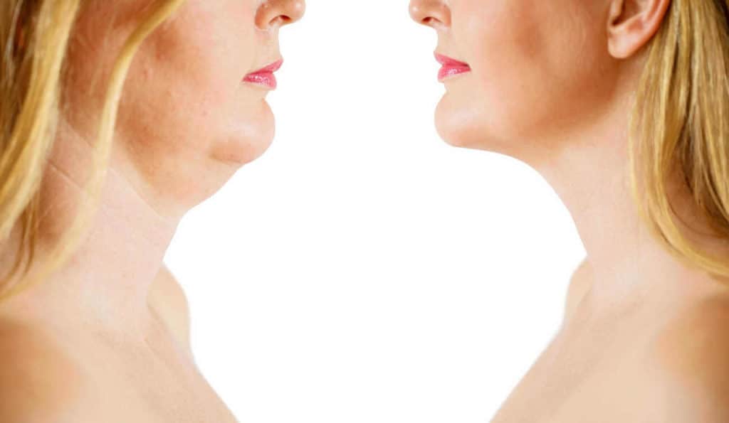 Double Chin treatment Biggleswade before and after results