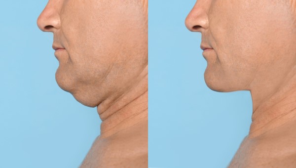 Which Non-Surgical Treatments Work Best for Jowls and Loose Skin Biggleswade?
