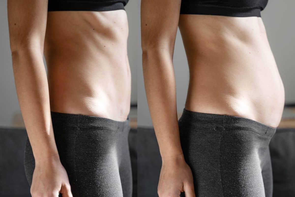 How long does diastasis recti take to improve Biggleswade?