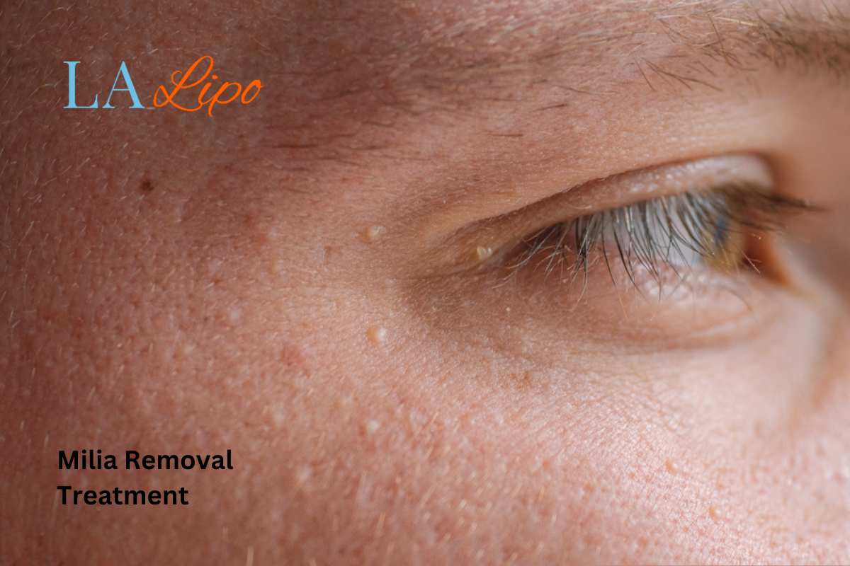 Cryopen Milia Removal: Is It the Easiest and Safest Option Biggleswade?