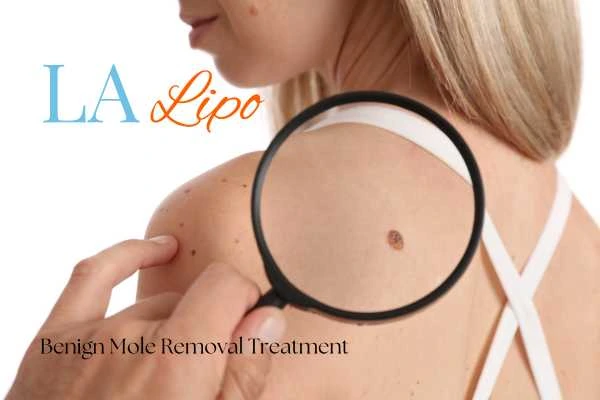 Why getting moles removed Biggleswade can boost your confidence!