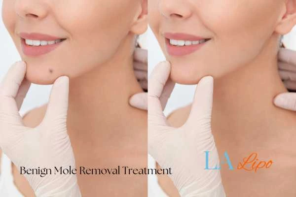 woman's before and after mole removal Biggleswade results