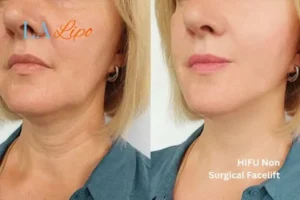 hi-fu for wrinkles Biggleswade before and after results