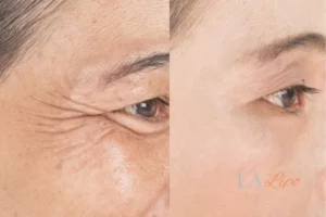 Before and after results of woman - HI-fu wrinkles reduction treatment Biggleswade
