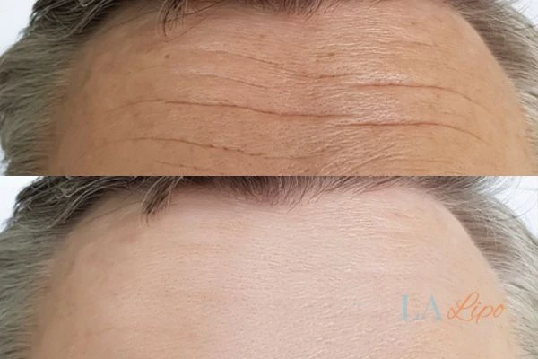 results of HIFU Biggleswade on mans forehead to help reduce lines and wrinkles