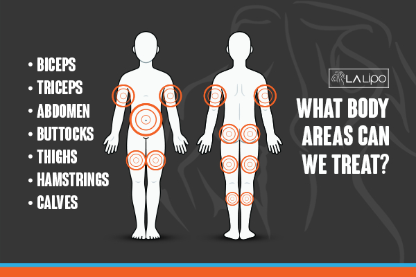 Graphic to show areas you can have LA-EMS Body Sculpting Biggleswade treatment.