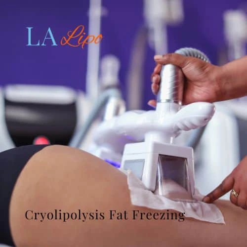 fat freezing - Cryolipolysis Biggleswade