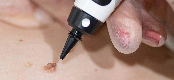 skin tag removal using cryopen Biggleswade