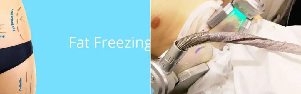 Fat freezing Biggleswade on multiple areas of the body