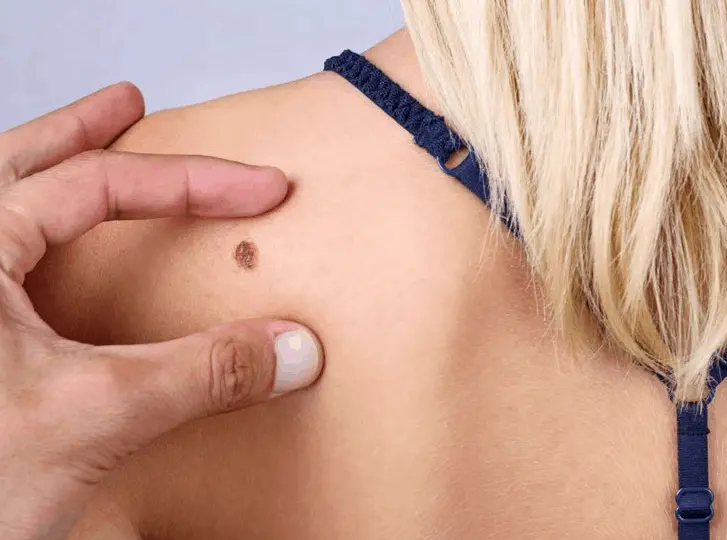 woman having mole removal Biggleswade consultation before treatment.