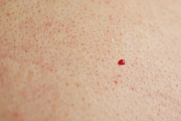 close up of a cherry angioma Biggleswade