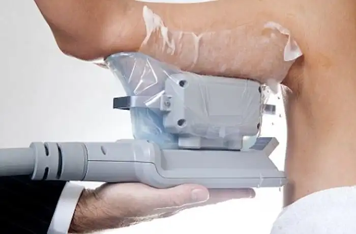 Picture of fat freezing Biggleswade on the upper arms.