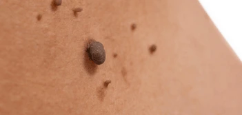 image of a skin tag Biggleswade