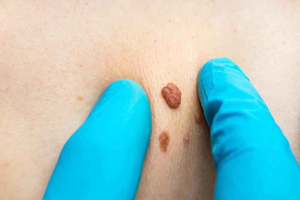 Consultant examining a skin tag Biggleswade