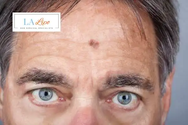 Solar Lentigo Removal Biggleswade image of man with mark on his forehead