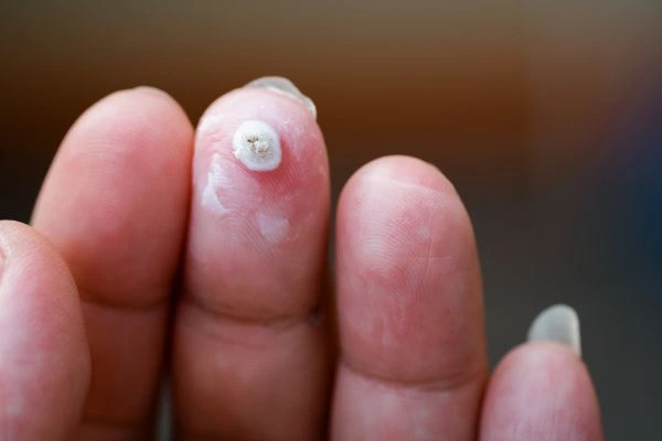 wart on person finger - cryotherapy to treat from LA LIPO Biggleswade