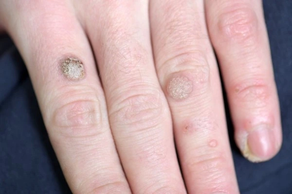 photo of warts on person hand - see wart removal Biggleswade from LA LIPO