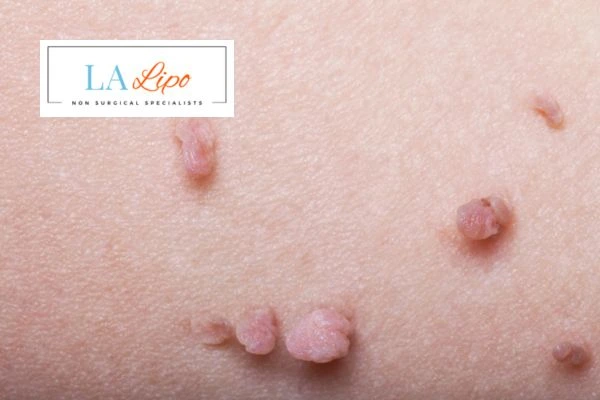 Does cryopen skin tag removal Biggleswade hurt? Find out now call our team today!