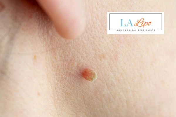 Book skin tag removal Biggleswade today speak to our team now!