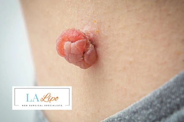 Interested in skin tag removal Biggleswade? Concerned about the pain? Find out more today!