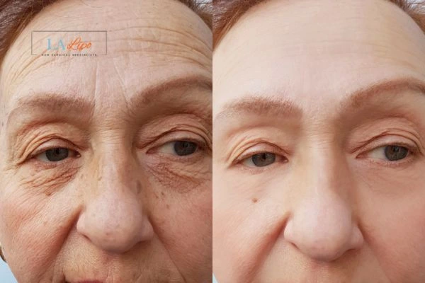 The powerful benefits of Morpheus8 Treatment Biggleswade - Call Our team today!