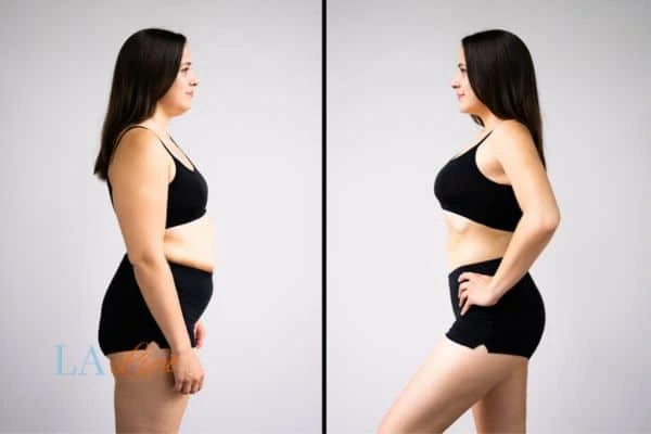 Picture of womans before and after using LA-EMS body sculpting to improve her core strength Biggleswade