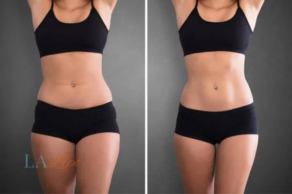 before and after results of non-surgical treatment to help a woman's body image and mental health Biggleswade