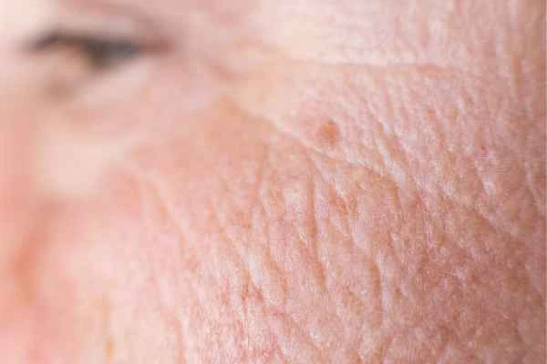 close up picture of a woman's face showing an age spot Biggleswade