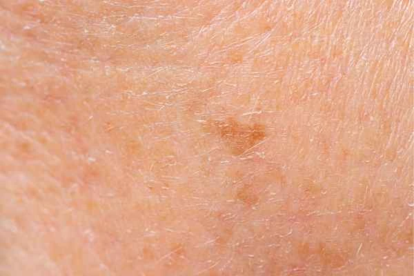 close up picture of age spots Biggleswade