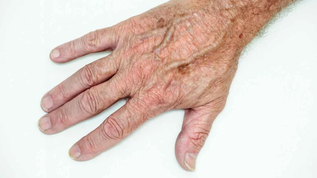 Male hand showing age spot Biggleswade
