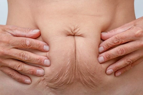 Image of a woman's stomach with loose skin - example of skin tightening Biggleswade options