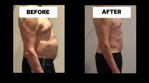 What Symptoms Can Diastasis Recti Cause in Men? Weak Core, Back Pain and Poor Posture Biggleswade